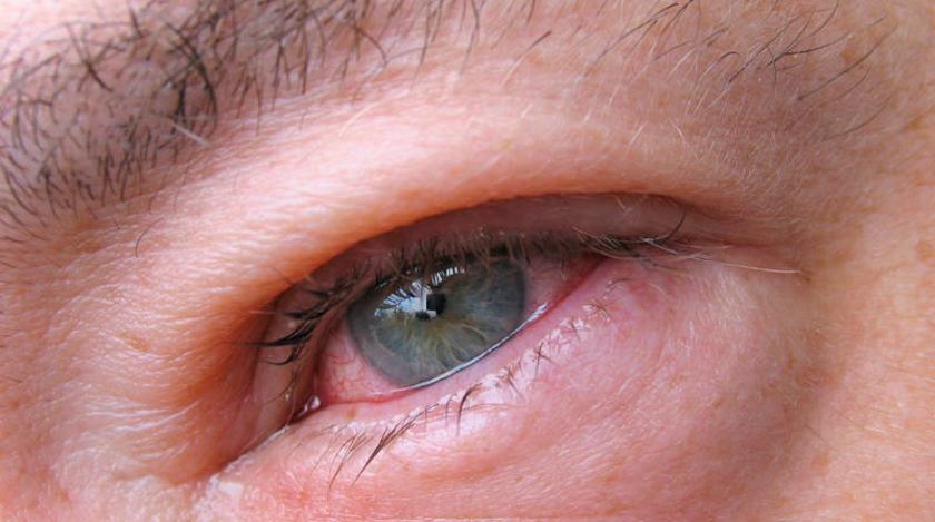 Названы самые бесполезные глазные капли во время аллергии