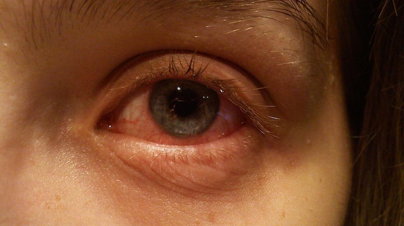 Аллергикам раскрыли три шага для подготовки к сезону цветения